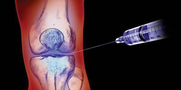 Фото укола в сустав Инъекции гиалуроновой кислоты при лечении суставов