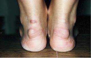 Бурсит пятки