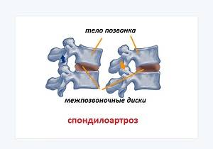 спондилоартроз поясничного отдела позвоночника