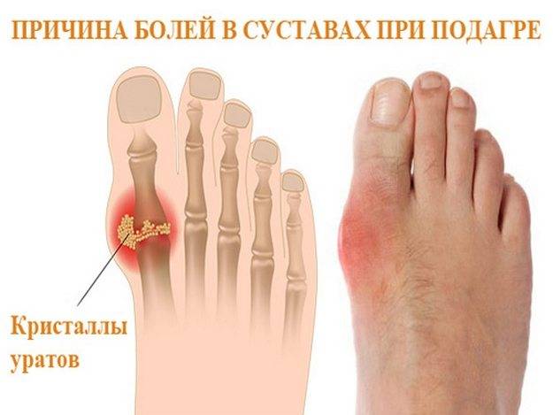 Подагра пальцев ног Подагра