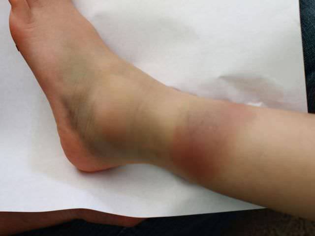 смещение голеностопного сустава травма голеностопного сустава