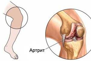 Гнойный артрит Гнойный артрит