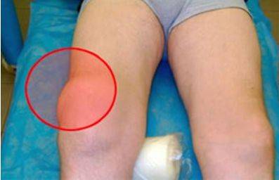 Почему ночью болят суставы