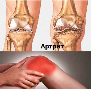 artrit-kolennogo-sustava