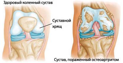 На фото остеоартрит Сустав, параженный остеоартритом