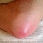 гнойный бурсит