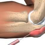 диагностирование гнойного бурсита