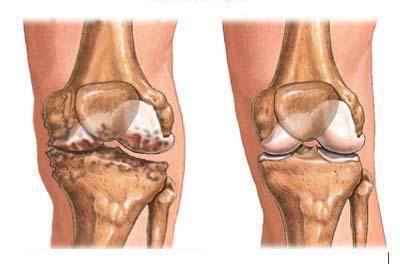 отложение солей