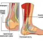 Ахиллобурсит