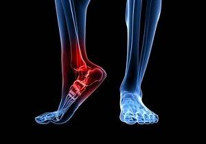 ревматоидный артрит лечение