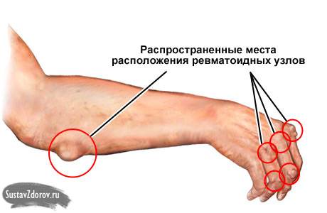 ревматоидные узлы ревматоидные узлы