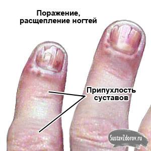 симптомы псориатического артрита симптомы псориатического артрита