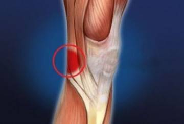 Боль в ноге под коленом сзади