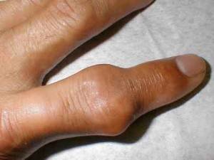 Стадия полиартикулярной подагры