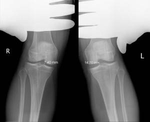 Суставная щель коленного сустава 26 300x244 Суставная щель коленного сустава