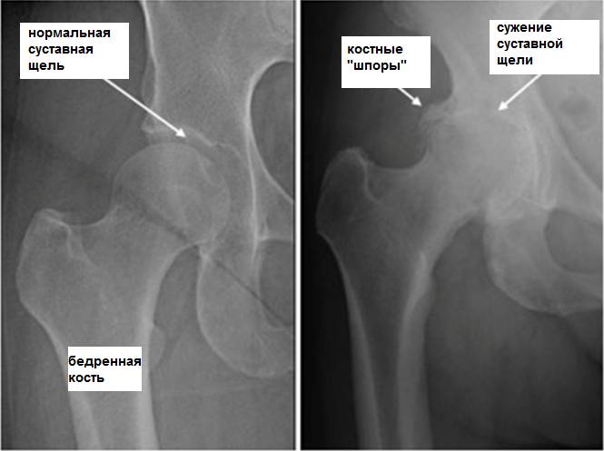 Сужена суставная щель коленного сустава